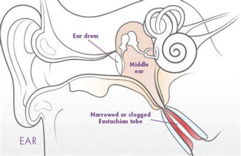 city clearing|Eustachian Tube Dysfunction .